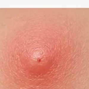 Wasp sting on skin